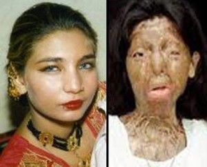 254428-pakistani-acid-attack-victim-fakhra-younus-committed-suicide-in-italy1-300x242