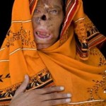 Bashiran-Bibi-acid-attack-victim1-150x150