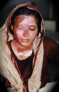 acid-attack-193x300