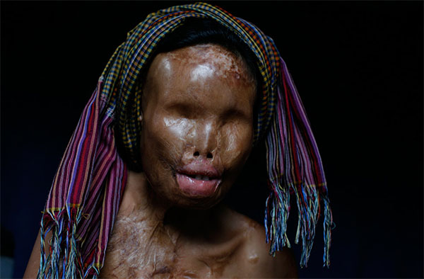 acid-attack-victim2