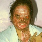 pakistan-revenge-acid-attacks2122813-150x150