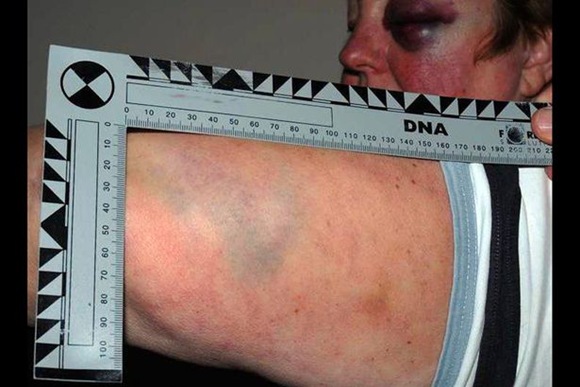 Sue Howard was left badly bruised by the attack Sue Howard was left badly bruised by the attack