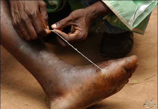 Guinea Worm Guinea Worm