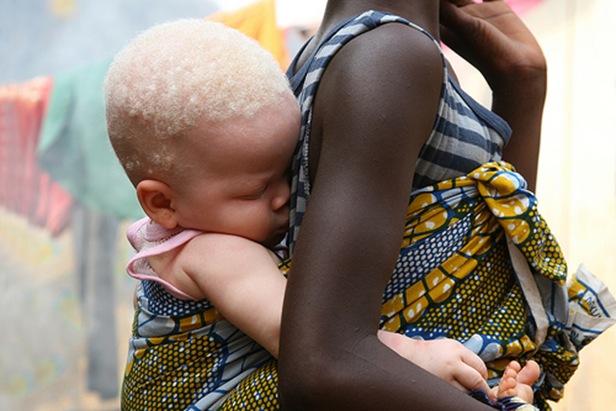 african_albino african_albino