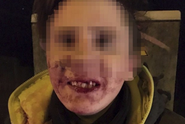 The most severely injured victim of the nonwhite attack in Chemnitz.