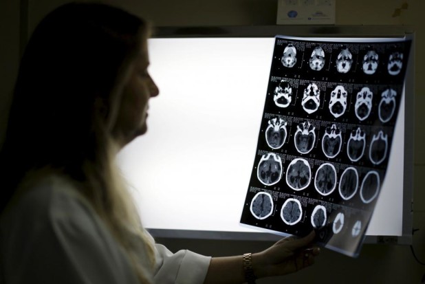 Child neurologist Vanessa Van Der Linden observes the X-ray of a baby's skull with microcephaly at the hospital Barao de Lucena in Recife, Brazil, January 26, 2016. Brazil has reported 3,893 suspected cases of microcephaly, the WHO said last Friday, over 30 times more than in any year since 2010 and equivalent to 1-2 percent of all newborns in the state of Pernambuco, one of the worst-hit areas. REUTERS/Ueslei Marcelino